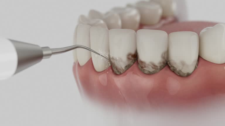 Trusted Wisdom Tooth Removal service in Lorain, OH - Dentist Open Now